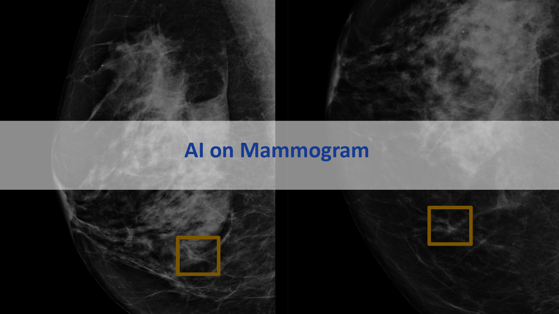AI on Mammogram