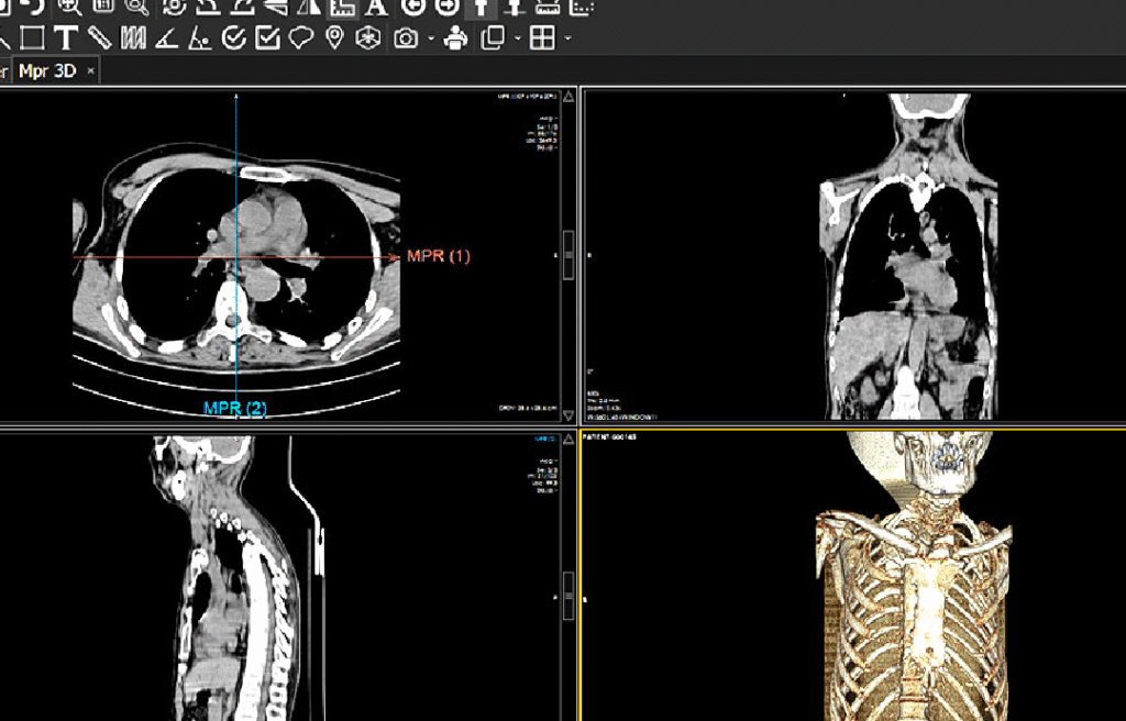 Multi-Planar Reconstruction (MPR)